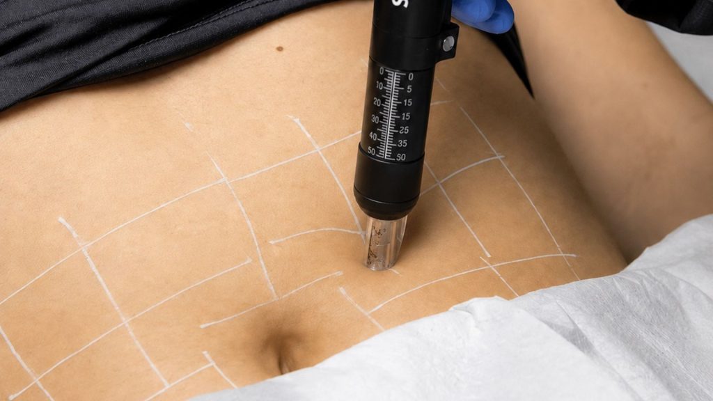 intradermoterapia pressurizada