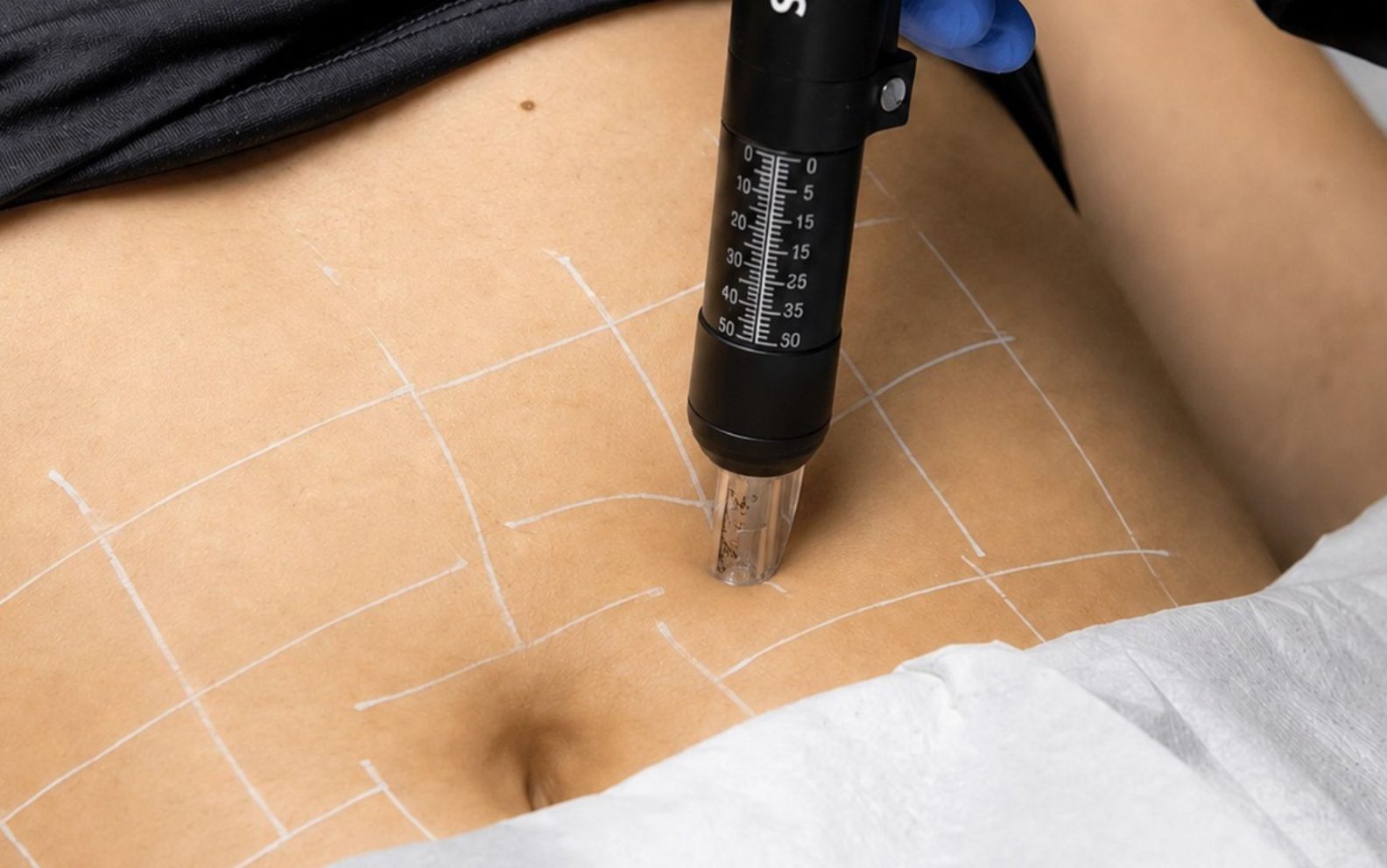 intradermoterapia pressurizada