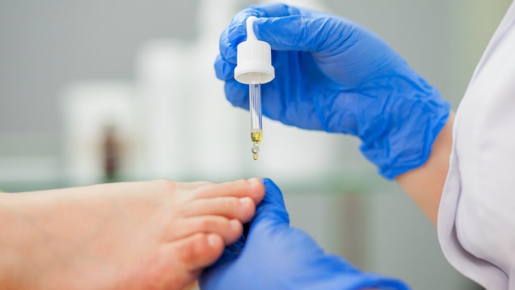 ATA – Ácido Tricloroacético Aplicado à Podologia ata acido tricloroacetico aplicado a podologia